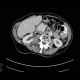 Hypervascular tumour of pancreatic head, hemangioma of vertebral body: CT - Computed tomography